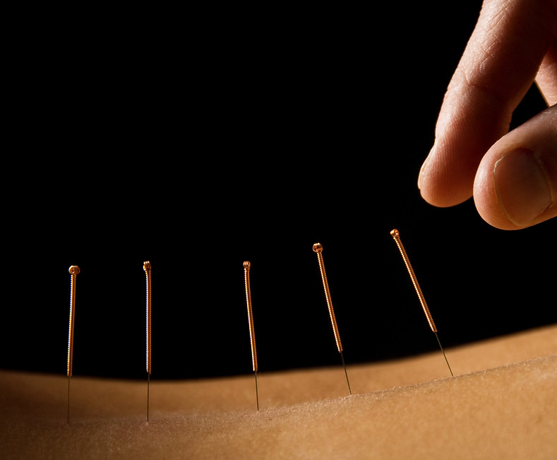 Acupuncture close up