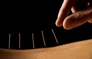acupuncture needles on back