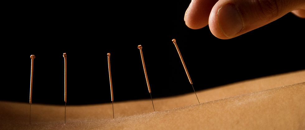 Acupuncture close up