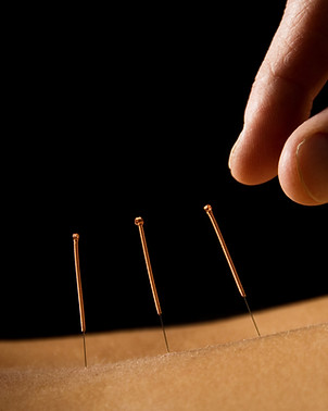 Akupunktur Terapi Sahnesi