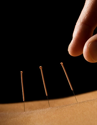 Acupuncture close up