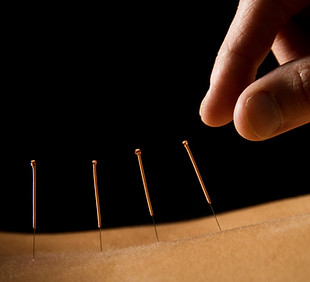 Acupuncture close up