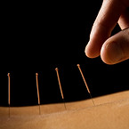 Acupuncture close up