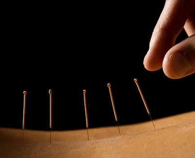Acupuncture close up