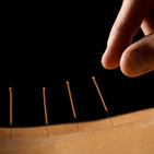 Acupuncture close up