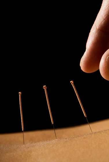 Acupuncture Therapy Scene