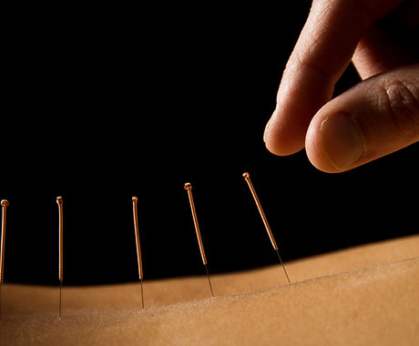 Acupuncture close up