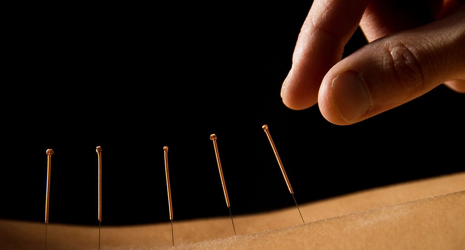 Acupuncture close up
