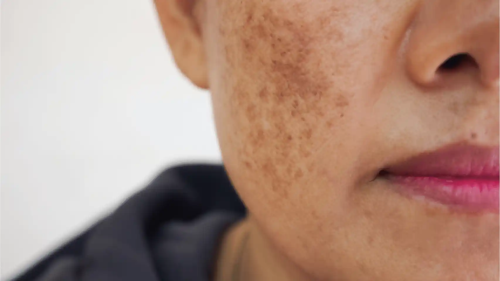 Melasma