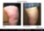 aggressive rapid medical weight loss