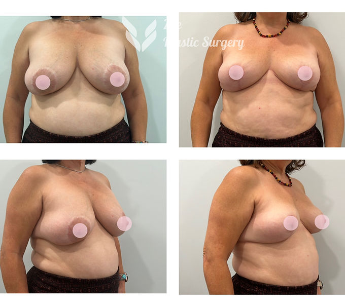 Breast Implant Removal
