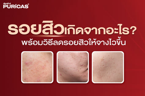 วิธีลดรอยสิวเร่งด่วน