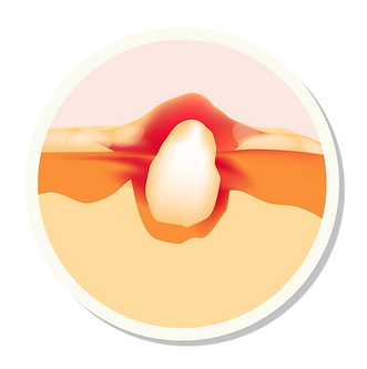 redesign-website_acne.png