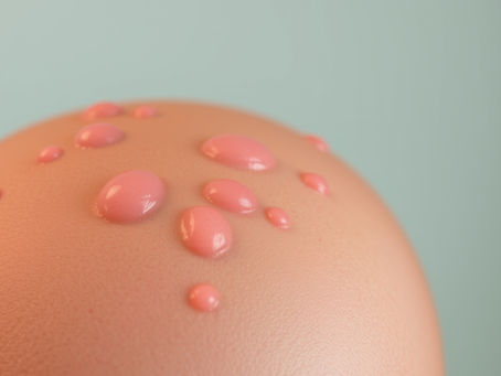 What’s Causing My Scalp Pimples—and Could It Be Hair Loss?