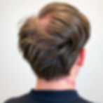 What to Do After Hair Loss Starts: Prevention Tips That Still Work