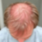 Hair Loss Prevention in Your 20s, 30s, 40s, and Beyond