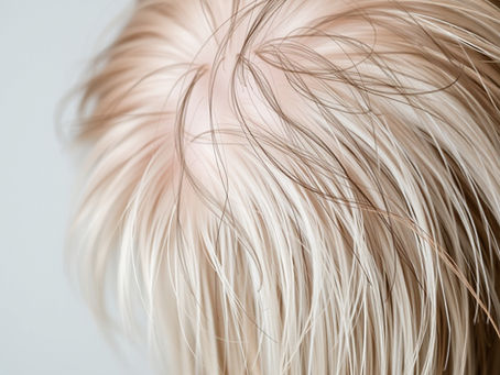 When to See a Hair Loss Specialist: Signs You Shouldn't Ignore