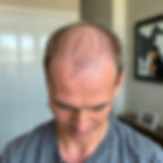 The 8 causes of men's hair loss