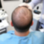 Risks of hair transplant vs non-surgical methods