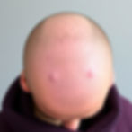 Understanding Alopecia: Types, Causes, and Treatments