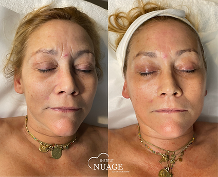 Résultat d'une séance de soin collagène du visage