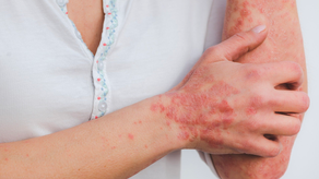 How to Make Eczema Go Away ?