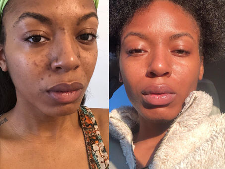 Seborrheic Dermatitis plagued my skin and shattered my self esteem: How I combat this skin condition