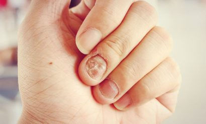 source: http://www.europeanpharmaceuticalreview.com/44231/news/industry-news/moberg-onychomycosis-trials/