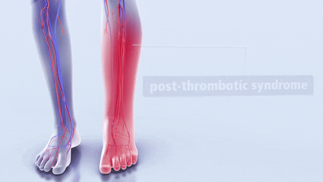 DVT.gif