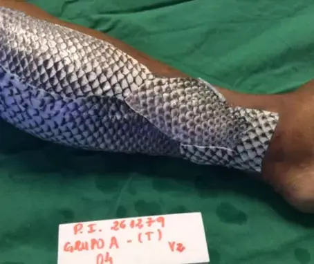 Nouveau traitement pour les brûlures: La peau de tilapia