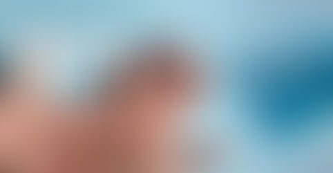 Missouri confirma primeros casos de variante más severa de mpox y refuerza llamado a la prevención