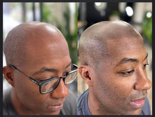 Scalp micropigmentation top areas $2000