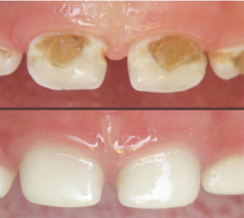11_Preformed Crowns 2.jpg