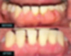 08_Gingivectomy and flap surgery 2.jpg