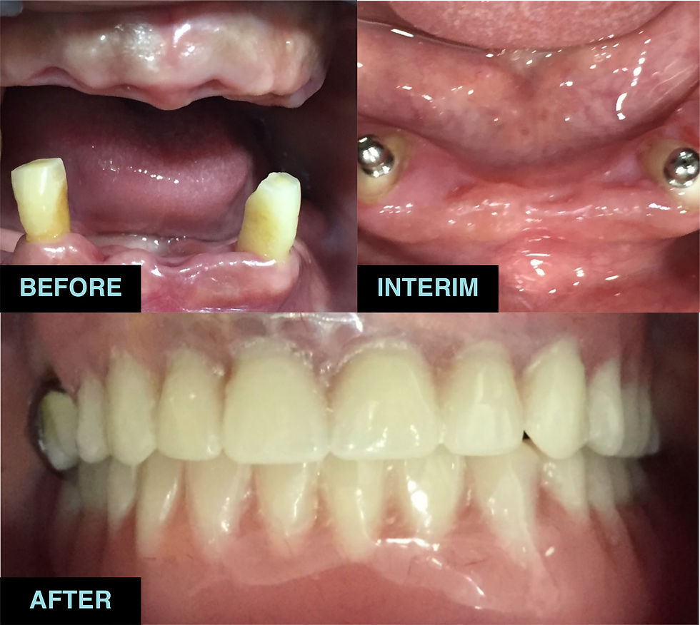 over dentures.jpg