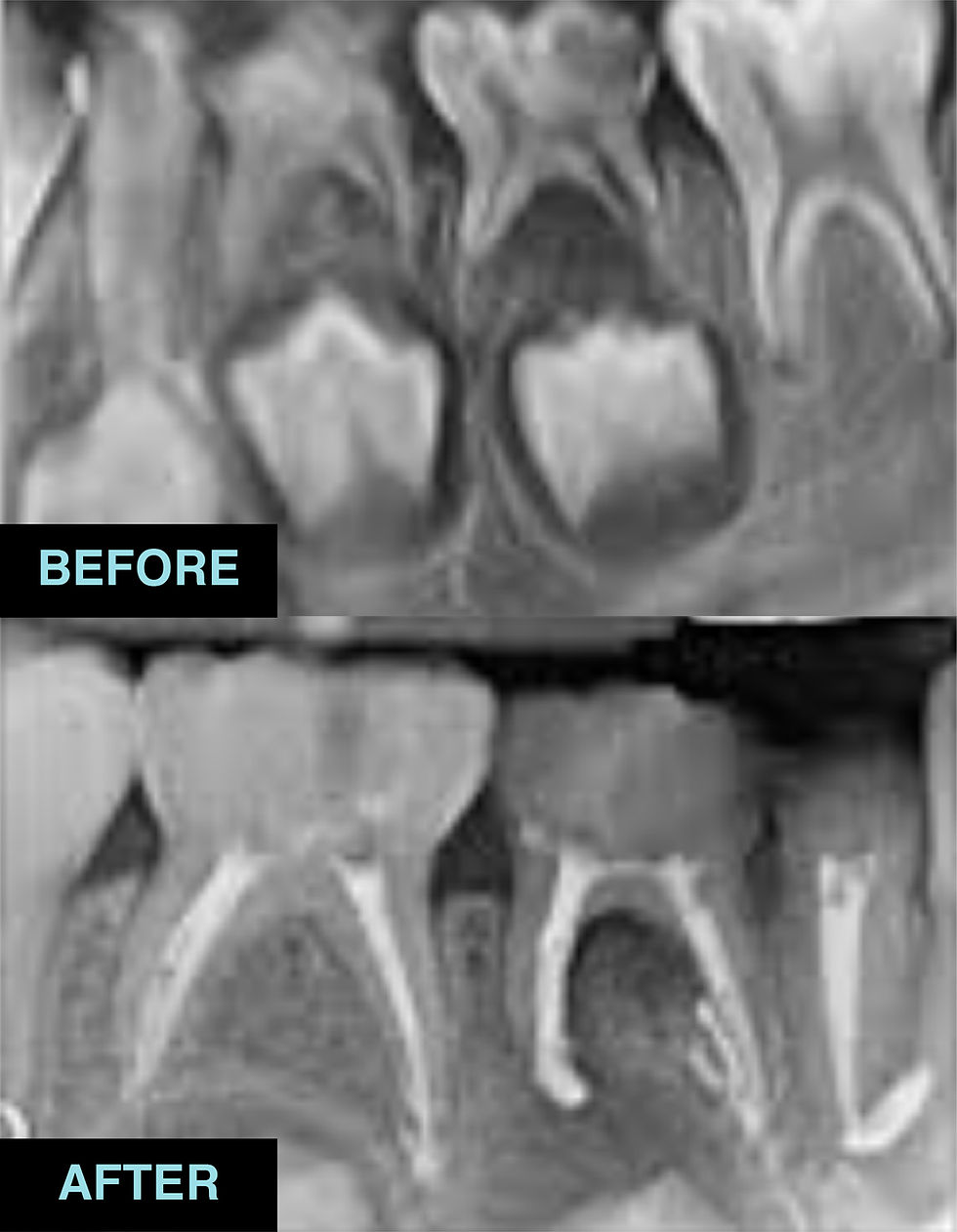 11_Fillings and root canal treatment 2.jpg