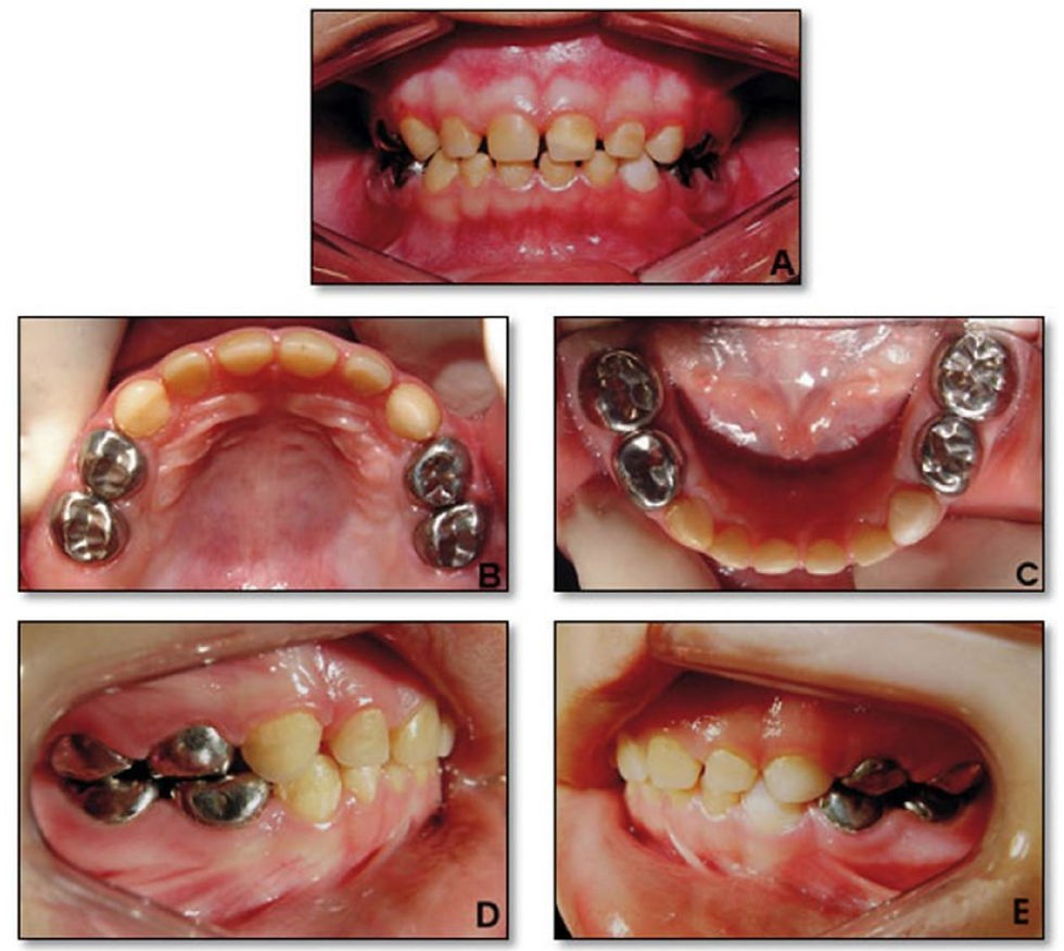11_Preformed Crowns.jpg