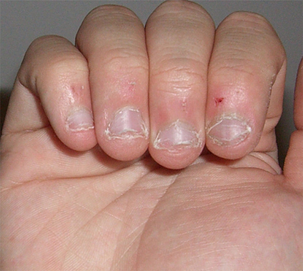 11_Nail Biting.jpg