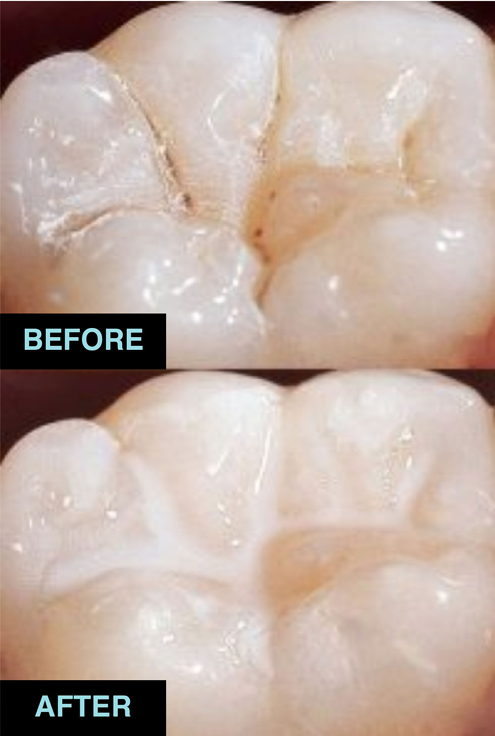 01_Pit and fissure sealants.jpg