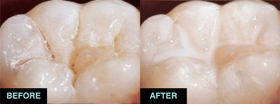 01_Pit and fissure sealants-05.jpg