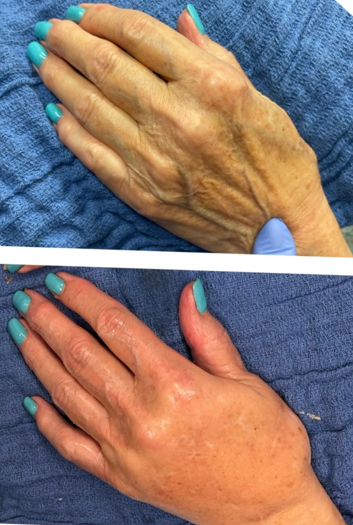 Fat Transfer to hand