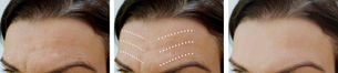 10 Tips to Make Your Botox Last and Look Amazing!