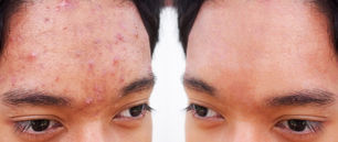 5 Solutions to Combat Summer Acne Breakouts and Achieve Clear Skin