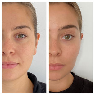 A New Bite on Botox