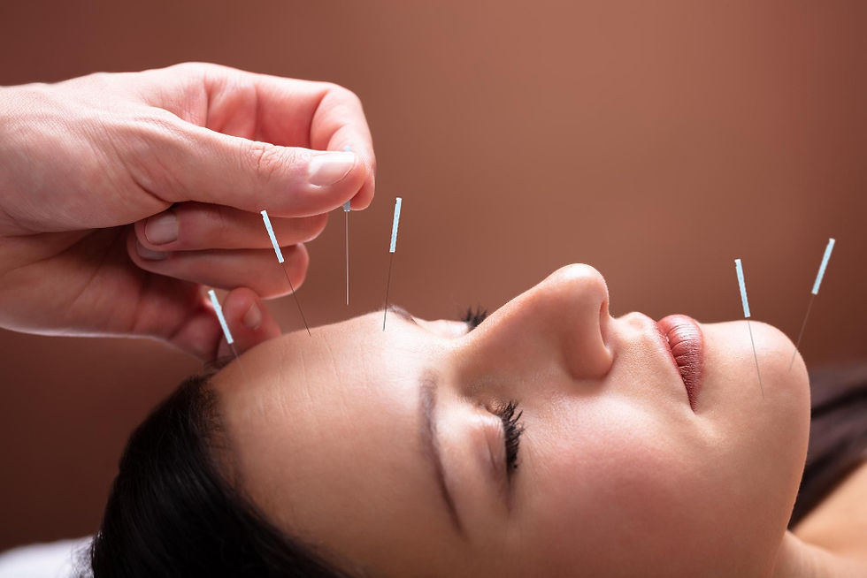 Acupuncture Fort Lauderdale