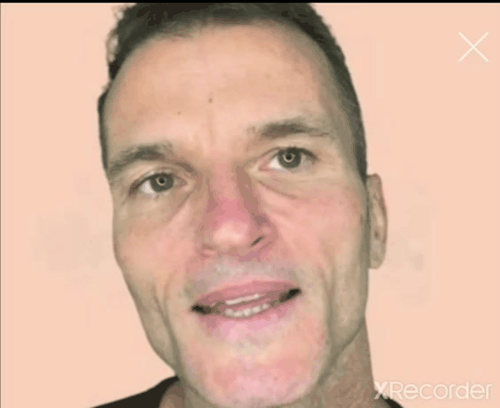 Lower Cheek Lift Assist