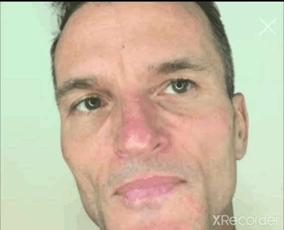 Upper Cheek Lift Handsfree