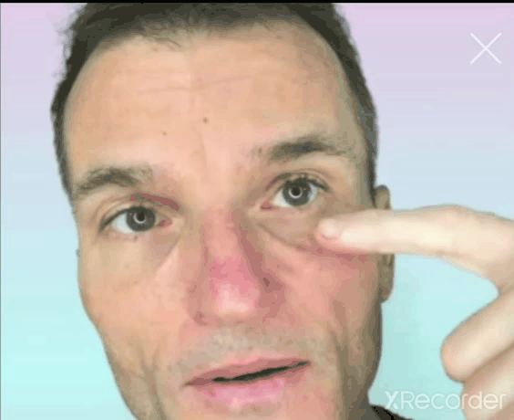 Upper Check Lift Assist Cheek Exercises