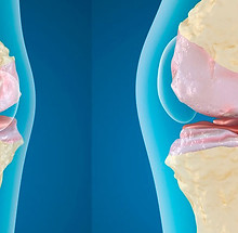 Lesiones-de-cartilago-en-rodilla.jpg