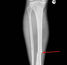 Transverse-fracture.jpg